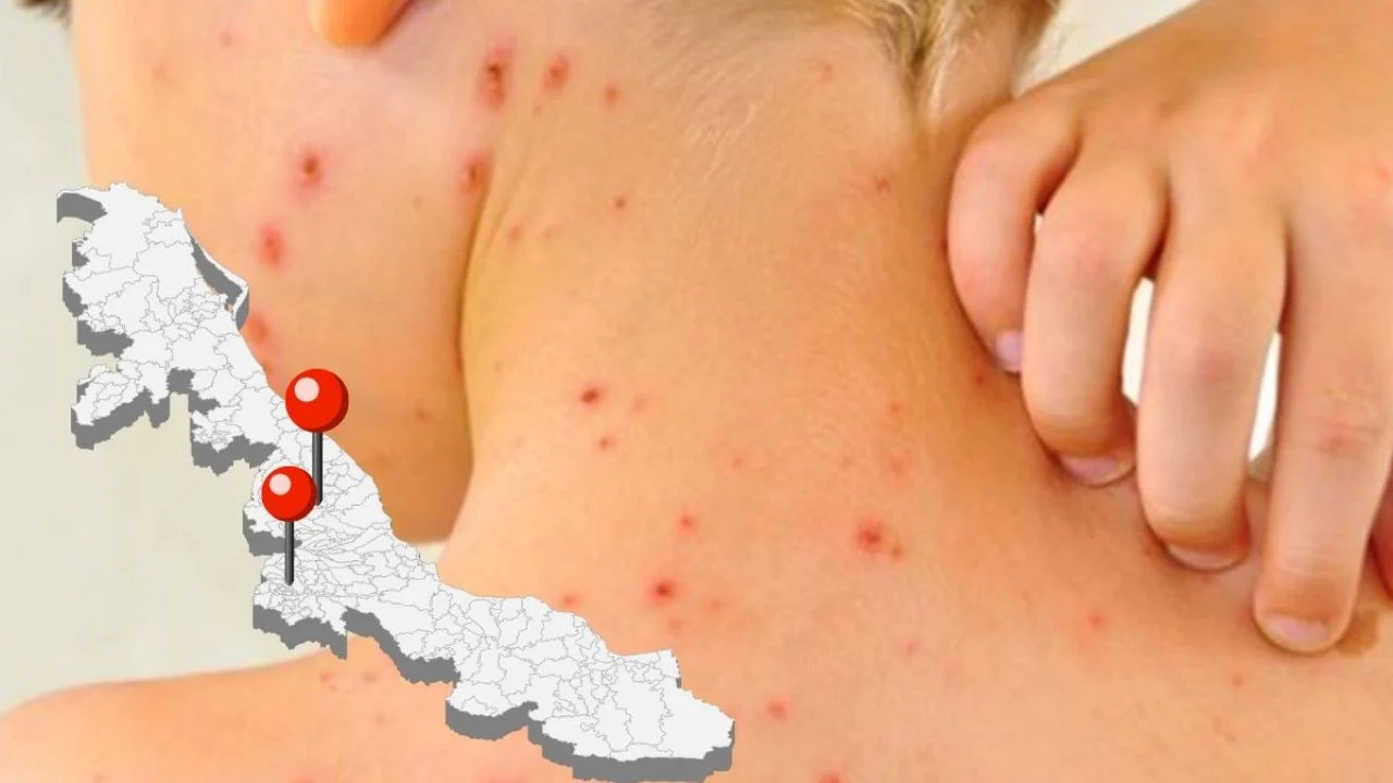 Brote de sarampión en Veracruz y campaña de vacunación 2026