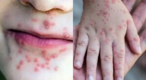 Alerta en Veracruz: Detectan 71 casos de virus Coxsackie