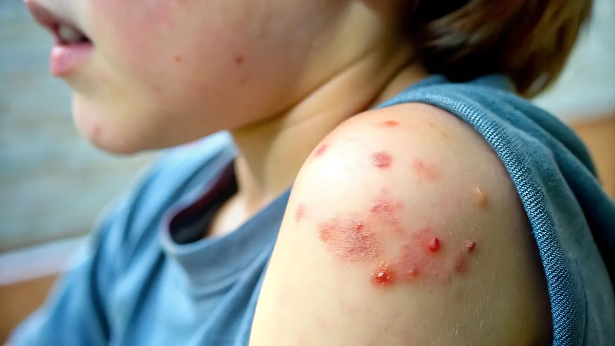 Campaña de vacunación contra el sarampión en México 2026