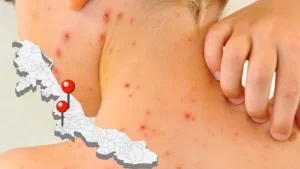 Sarampión en Veracruz: Reportan 21 casos